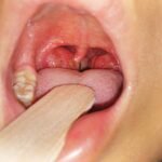 Safe Tonsil Removal Services in Singapore